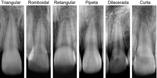Figura 3. Classificação morfológica das raízes dos incisivos superiores nas radiografias pré-tratamento.
