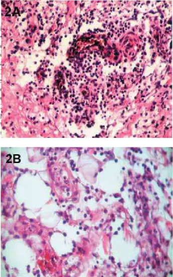 Figure 3- Photomicrographs of histological samples after  15 days of implantation. A: formation of granulomas with 