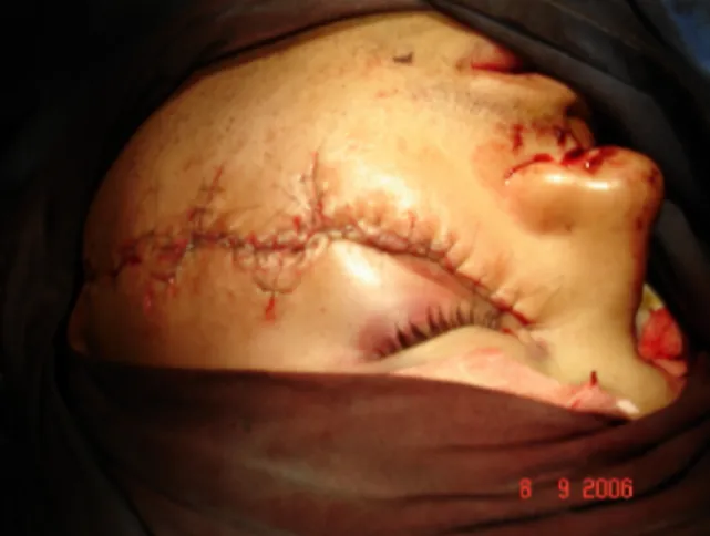 Figura 2. Aspecto clínico do paciente vítima de ferimento por projétil de arma de fogo após o término da sutura.