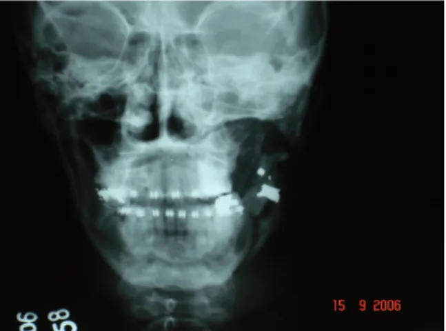 Figura 5. Aspecto radiográfico frontal.