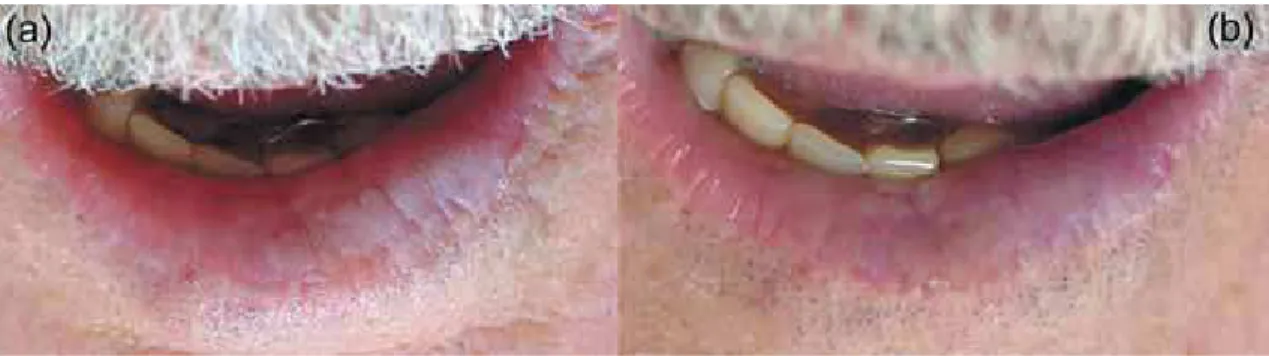 Figure 2- Actinic cheilitis grade IV with leukoplakic and spotting areas (a). Lesion showed total remission of the leukoplakic  area, however, spotting areas continued to be present (b)