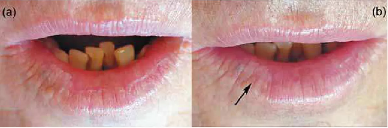 Figure 4- Gender, age and grade of actinic cheilitis of  the 27 patients who completed the therapy, as well as,  period and results obtained with the topical application of  diclofenac