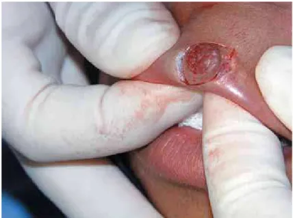 Figure 2- Excisional biopsy to remove the nodule