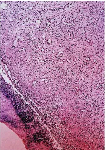 Figure 4- Labial aspect 6 months (A) and 4 years (B) postoperatively