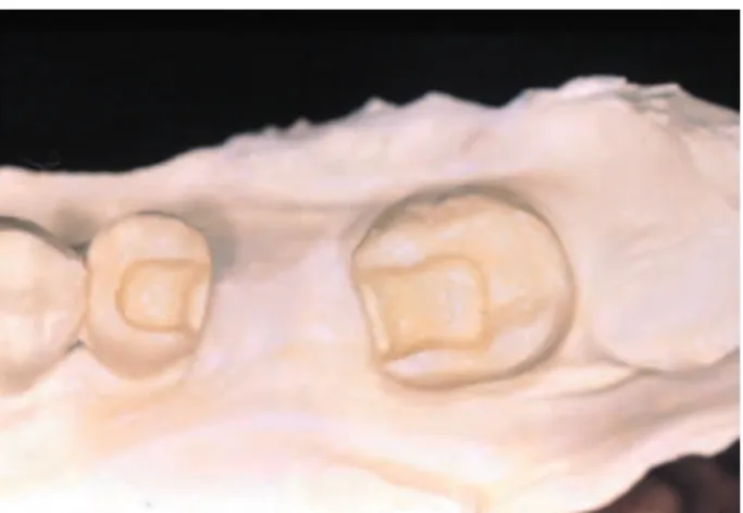 Figure  3-   The  ixed  partial  denture  is  completed  with  additional composite layers