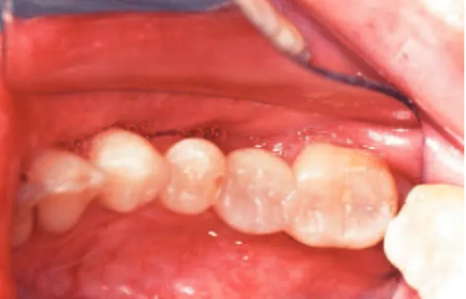 Figure 7-  Survival functions of iber-reinforced ixed partial dentures according to composites combinations