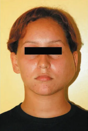 Figure 1- Anteroposterior facial view illustrating the 6 x 5  cm swelling on patient’s left cheek