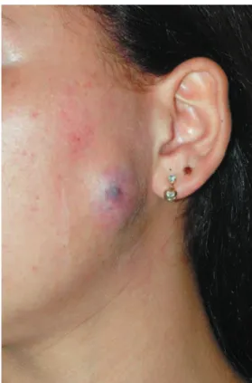 Figure 5- Complete recovery of the skin and remission of  the swelling after 30 days