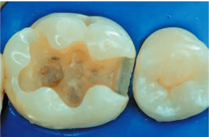 Figure 5- Dental surface aspect after acid-etching when a  water-based system is used