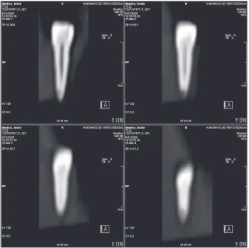 Figure 1- Series of coronal CT sections showing cavities on apical and middle thirds