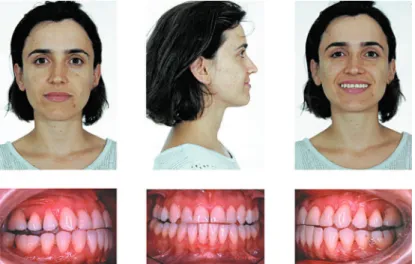 Figure 1- Pretreatment facial and intraoral photographs (patient signed informed consent authorizing the publication of  these pictures)