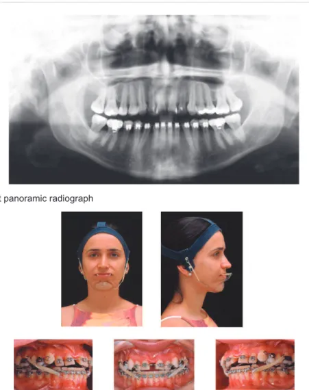 Figure 4- Treatment facial and intraoral photographs (patient signed informed consent authorizing the publication of these  pictures)