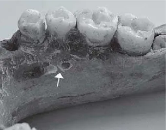 Figure 1- Right side of a dry mandibular body. The arrow shows lingual cortical and medullar simulated perforations