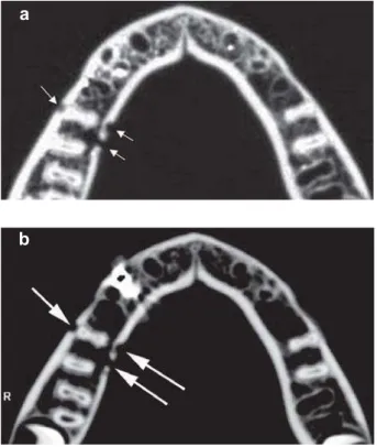 Figure 2- a) Axial CT of the mandible without metallic restorations and prostheses. The arrows indicate one cortical perforation in the buccal side and two perforations in the lingual side (right side)