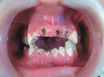 Figure 2- Preoperative panoramic radiograph showing teeth with periapical lesions