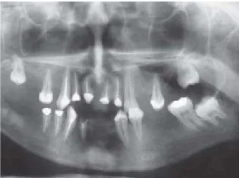 Figure 4- Panoramic radiograph taken 6 months after the endodontic treatment. Note a remarkable decrease of the radiolucencies