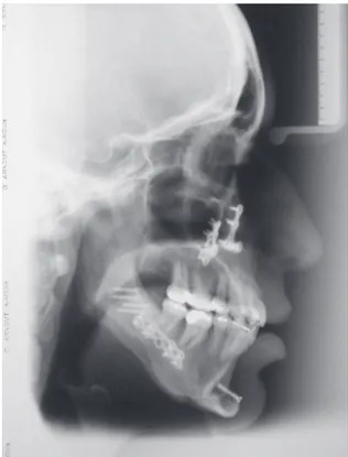 Figure 7- Fourteen-month cephalometric radiograph showing occlusion plane changing and lower jaw advancement