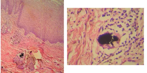 Figure 1- Panoramic radiograph showing a radiopaque lesion in the right oral mucosa (arrow)