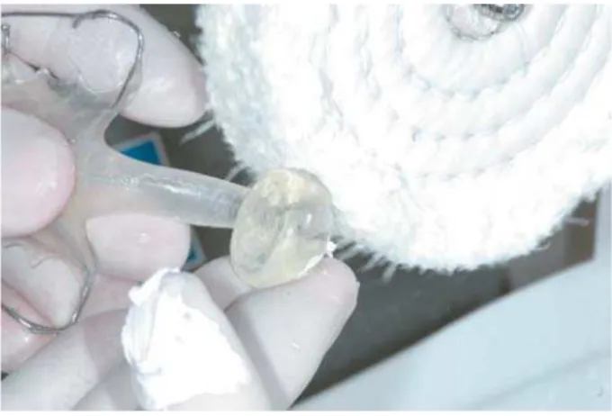Figure 5- Pharyngeal obturator reduction with grinding  paste – phase of polishing