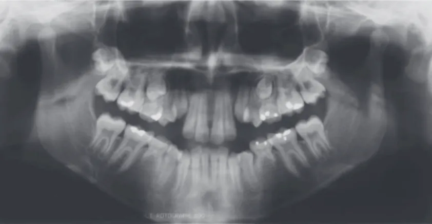 Figure 1- Preorthodontic panoramic radiograph