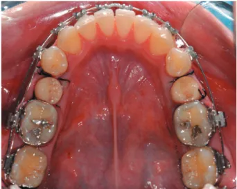 Figure 4- Occlusal view showing the distal space after  cementation of the provisional crown