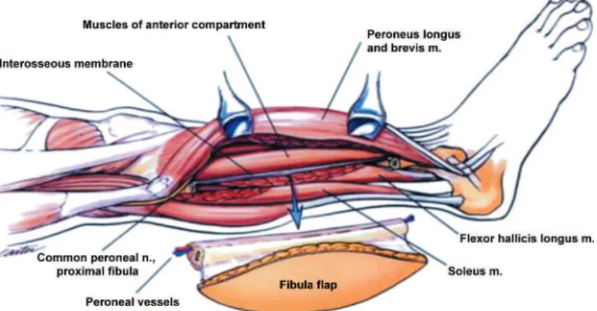 Figure 3- Lateral view of the right leg. Note the proximity of the common peroneal nerve to the proximal osteotomy, according  to Anthony and Foster 6  (1996)