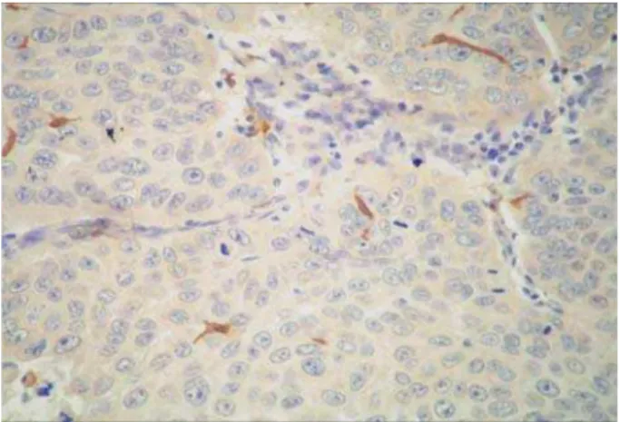 Table 1- Cases categorized according with the median  number of Langerhans cells immunostained, presence or  DEVHQFHRI+39LQIHFWLRQDQGVWDWLVWLFDOVLJQL¿FDQFH Figure 3- Immunostained Langerhans cells in a HPV-positive case of oral squamous cell carcinoma (SAB