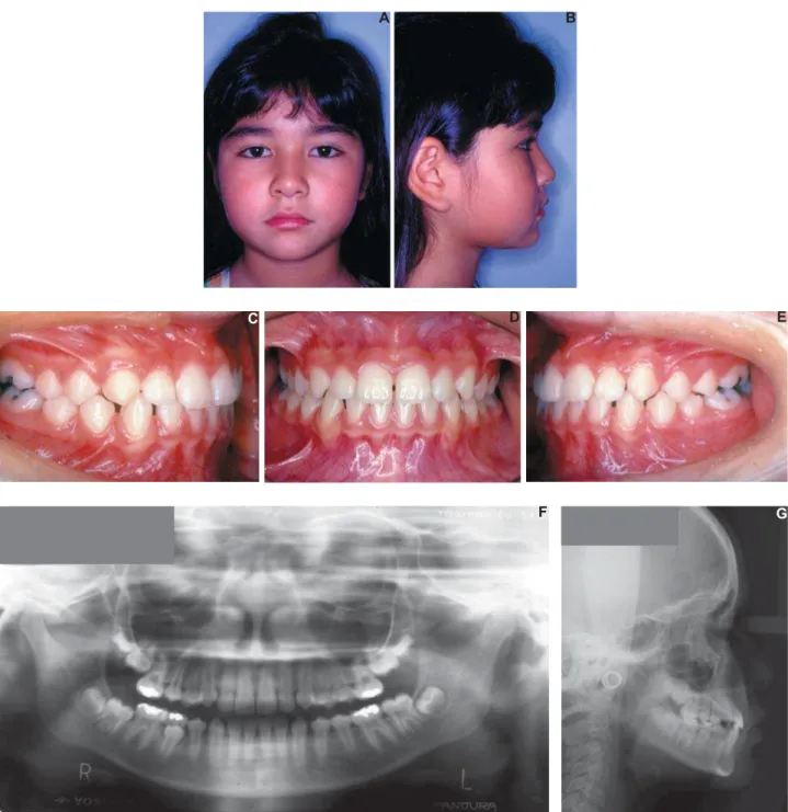 Figure 4- End of interceptive phase: extraoral (A and B) and intraoral (C-E) photographs at the end of the interceptive  phase, panoramic x-ray (F) and lateral cephalogram (G) (parents signed informed consent authorizing the publication of  these pictures)