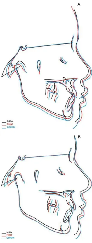 Figure 9- Superposition of initial, final, and follow- follow-up cephalometric tracings of interceptive phase (A)