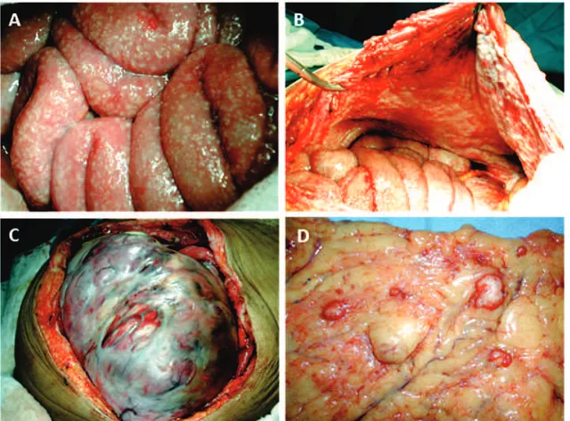 Figura 1.1 (A-D): Laparotomia para citorredução primária do câncer de ovário.