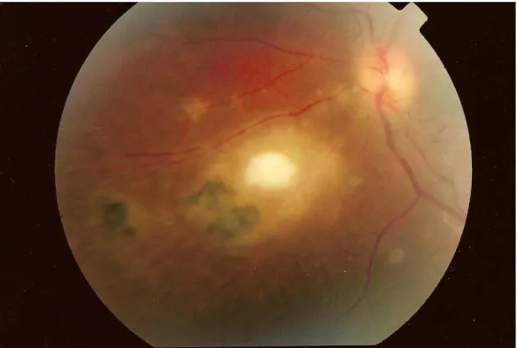 Figura 1 – Retinografia de paciente do Grupo Uveíte evidenciando lesão de  retinocoroidite em atividade e opacidade vítrea classificada como 1+/4+