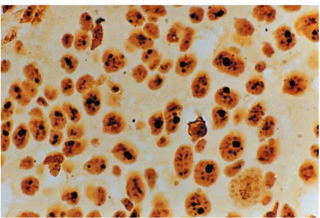 Figure 4-  Undifferentiated oral squamous cell carcinoma (OSCC) presenting great amount and highly stained nucleolar  organizer regions (NORs), some of which are grouped (1,000x)