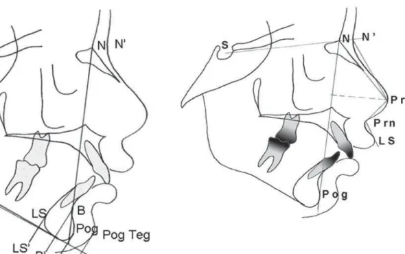 Table 2- Deviation comparison according to breathing modeFigure 3-  Pogonium  cephalometric  tracing  with  linear measurements