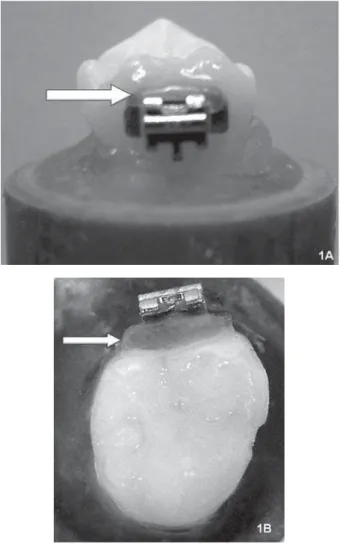 Figure 1- Specimen preparation. Group 1: with application  of an additional layer of adhesive in the occlusal teeth/tube  interface (A: vestibular view; B: occlusal view)