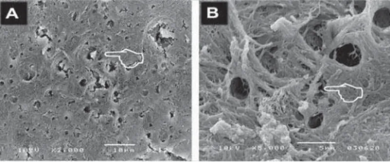 Figure 5- Scanning electron microscopy (A and B) of the morphology of root surfaces treated with simultaneous manual    " %" ;!#  