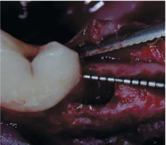Figure 1- Clinical view of the surgically created 3-wall  intrabony defect (4x4x4 mm) at the mesial aspect of the 