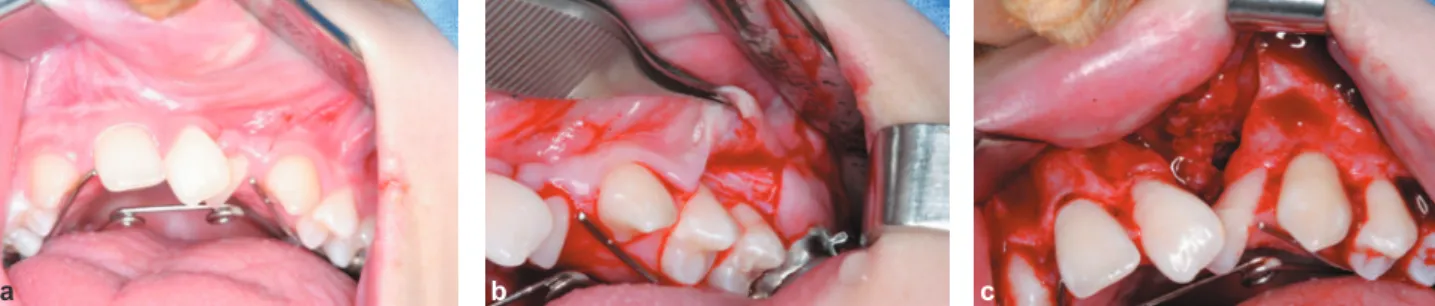 Figure 5- Placement of cancellous bone from the iliac 