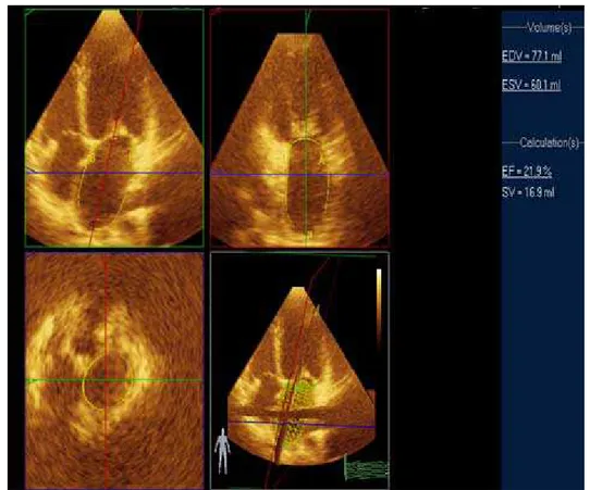 FIGURA 5 – Medidas dos volumes e da fração de esvaziamento do átrio esquerdo  por meio da ecocardiograma tridimensional 