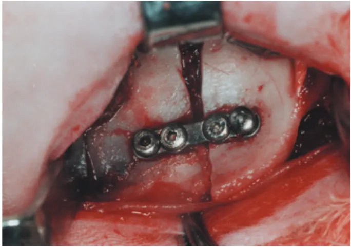 Figure 1- Fixation of bone segments with hybrid  microplate and microscrews