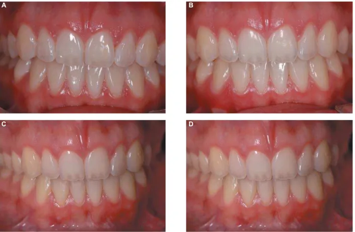 Figure 4- Control after: (A) 24 hours; (B) 1 month; (C) 12 months; (D) 24 months