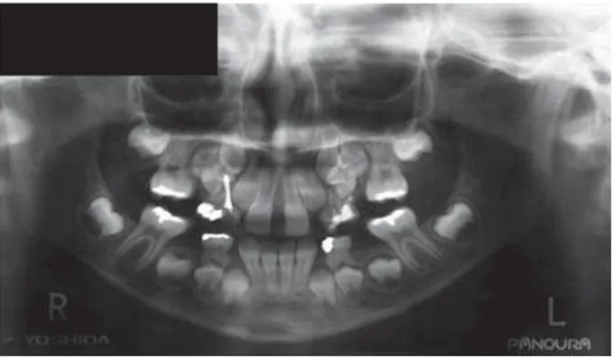 Figure 4- Intermediate phase showing the anchorage  preparation in the upper arch, and the reduction of the  diastema (A-C)