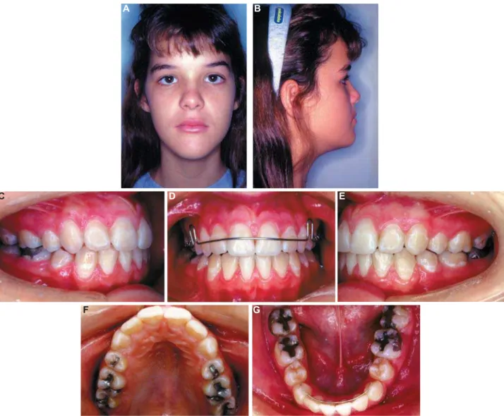 Figure 7- End of comprehensive phase: extraoral (A and B) and intraoral (C-G) photographs (the parents authorized the  publication of these pictures)
