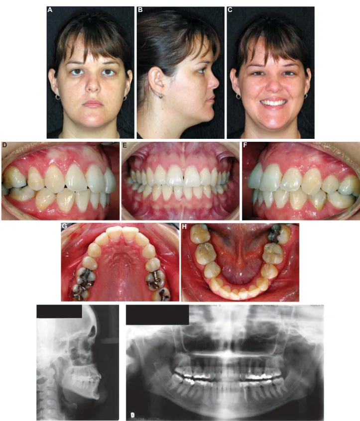 Figure 8- Twenty-year follow-up after the interceptive stage: extraoral (A-C) and intraoral (D-H) photographs, lateral  cephalogram (I), panoramic radiograph (J) (the parents authorized the publication of these pictures)