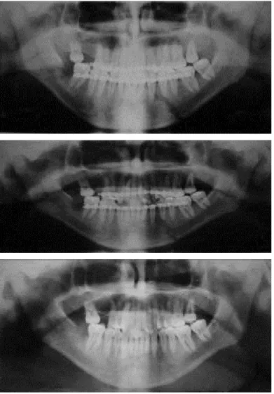 Figura 2. Sequência de radiografias panorâmicas após tratamento conservador da fratura de mandíbula.