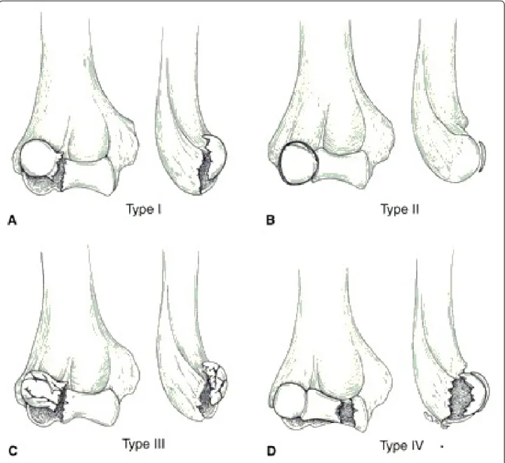 Figure 1 Bryan and Morrey classification of capitellar fracture.