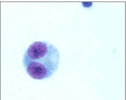 Figura 4  – Fotomicrografia de linfócito binucleado (BC) contendo micronúcleo (MN)  corado por Giemsa (observado sob aumento de 1000 X)