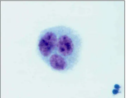 Figura 10 - Fotomicrografia de linfócito trinucleado (TC) corado por Giemsa (observado  sob aumento de 1000 X)