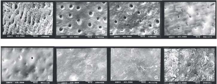 Figure 1-  Root  Modiication  Index.  A)  Score  1.  Complete  smear  layer  removal  with  dentin  collagen  iber  exposure