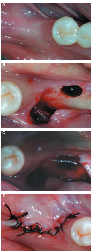 Figure 1- Prepare of donor site. (A) Occlusal view from  edentulous ridge selected for the creation of a surgical  alveolus; (B) Rising of a full thickness lap and creation  of a surgical socket by perforation of alveolar ridge with  a diamond bur in high 