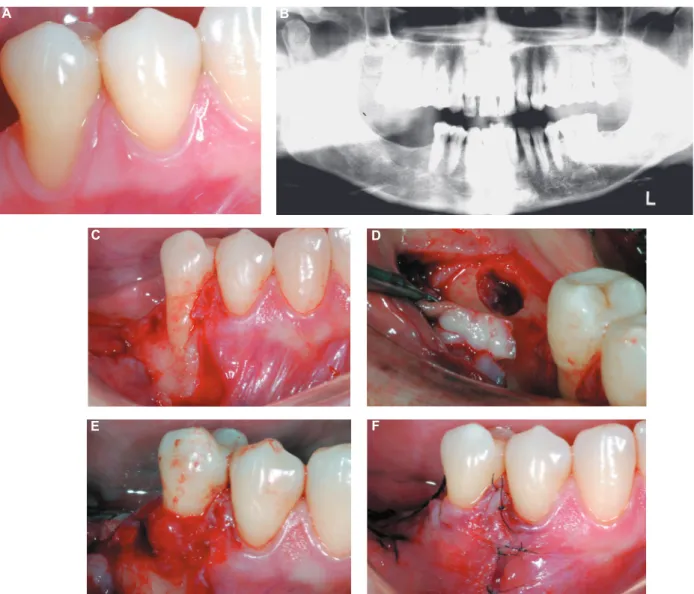 Table 1 describes RD, PD, CAL, BOP, PI, KGW  and the percentage of root coverage observed at  buccal sites at baseline and at the postoperative  examinations for all cases described